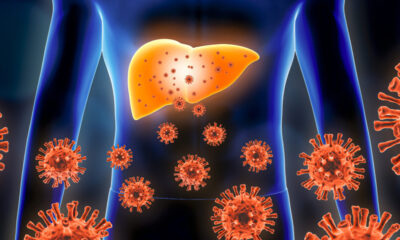 HEPATITIS