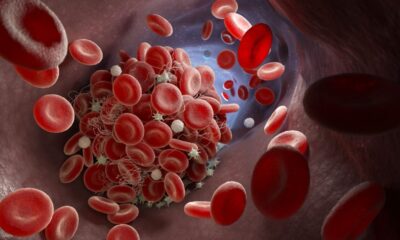 ds hemofilia 3