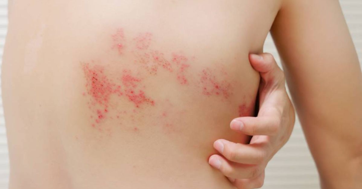 ds herpes