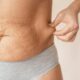 flacidez abdominal