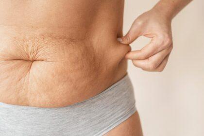 flacidez abdominal scaled