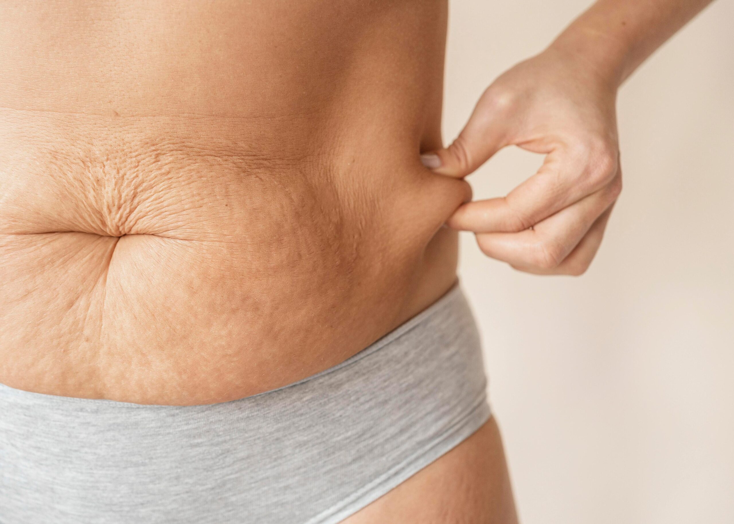 flacidez abdominal scaled