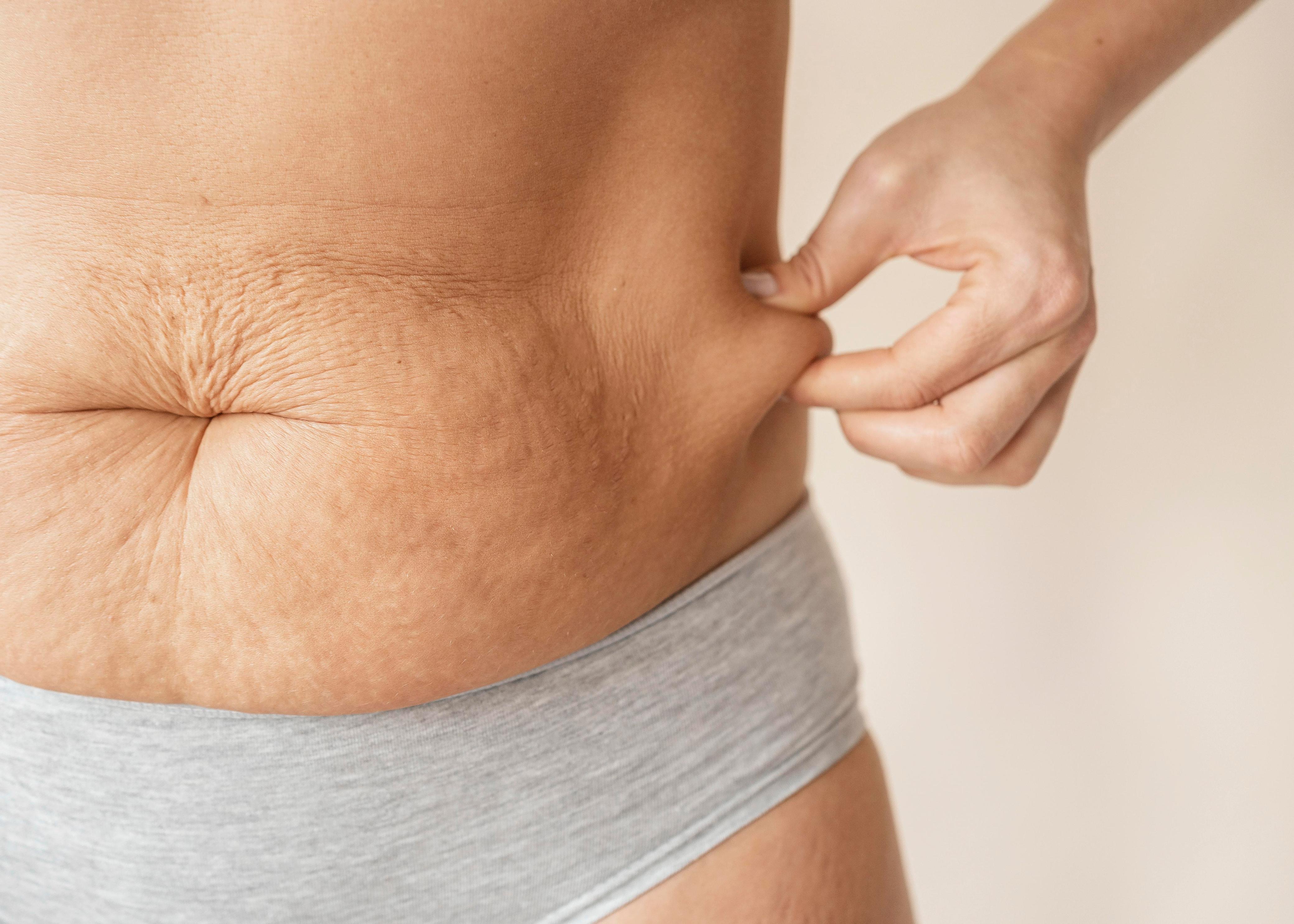 flacidez abdominal