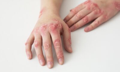 u psoriasis
