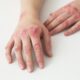 u psoriasis